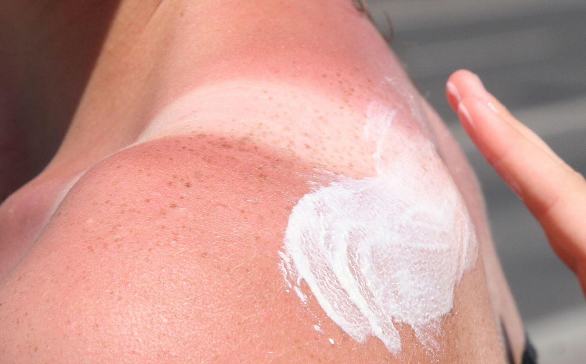 Sonnenbrand ist gefährlich - es drohen Langzeitfolgen. (Bild: Stephanie Pilick/dpa/dpa-tmn)