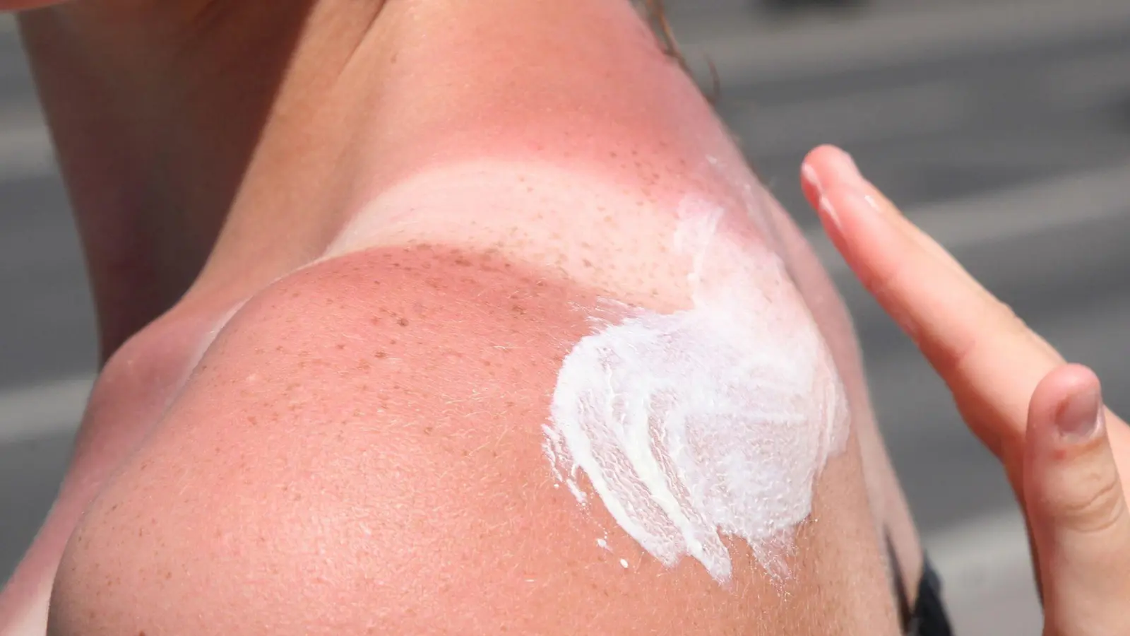 Sonnenbrand ist gefährlich - es drohen Langzeitfolgen. (Bild: Stephanie Pilick/dpa/dpa-tmn)